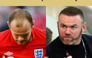 Wayne Rooney Hair Transplant Journey