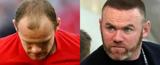 Wayne Rooney Hair Transplant Journey