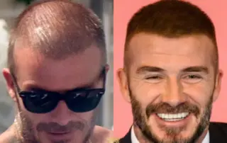 david beckham hair transplant featured image