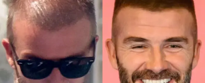 david beckham hair transplant featured image