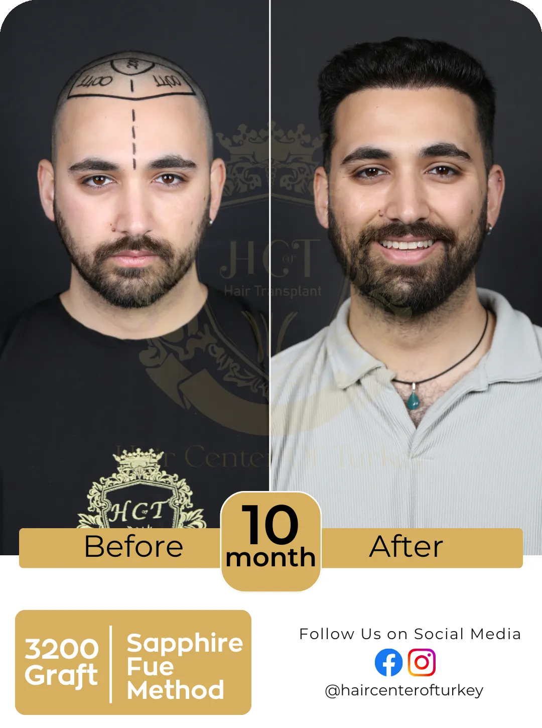 Hair Transplant Before And After