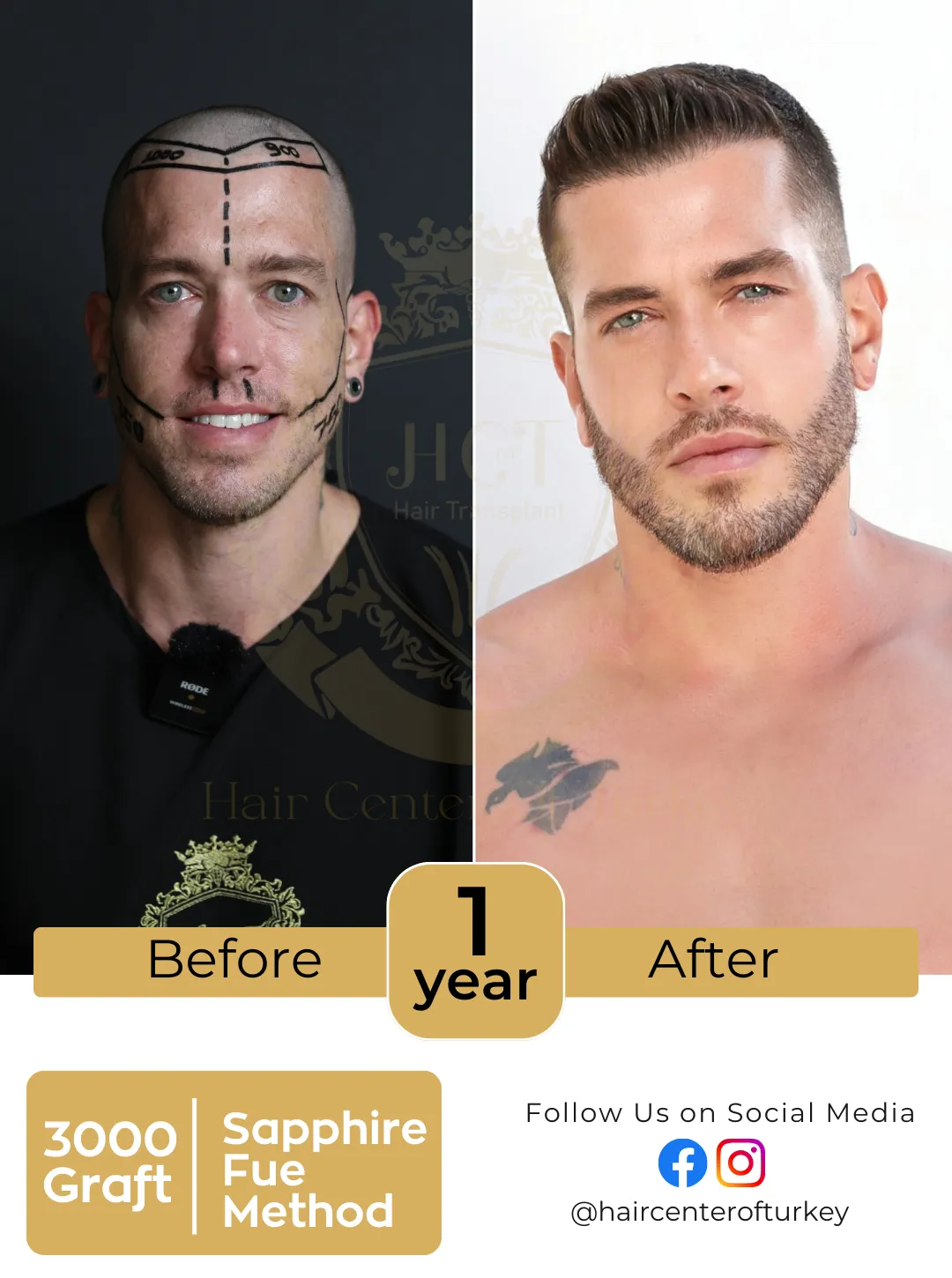 Hair Transplant Before And After