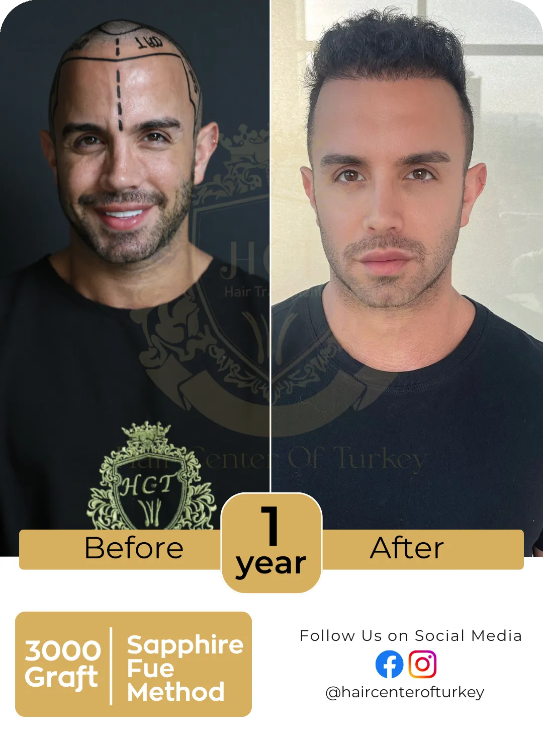 Hair Transplant Before And After