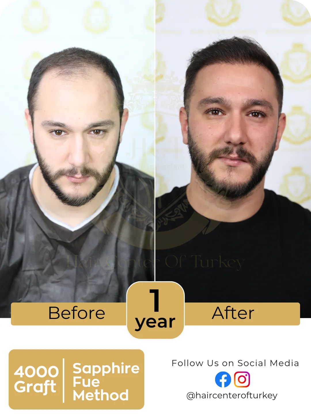 Hair Transplant Before And After