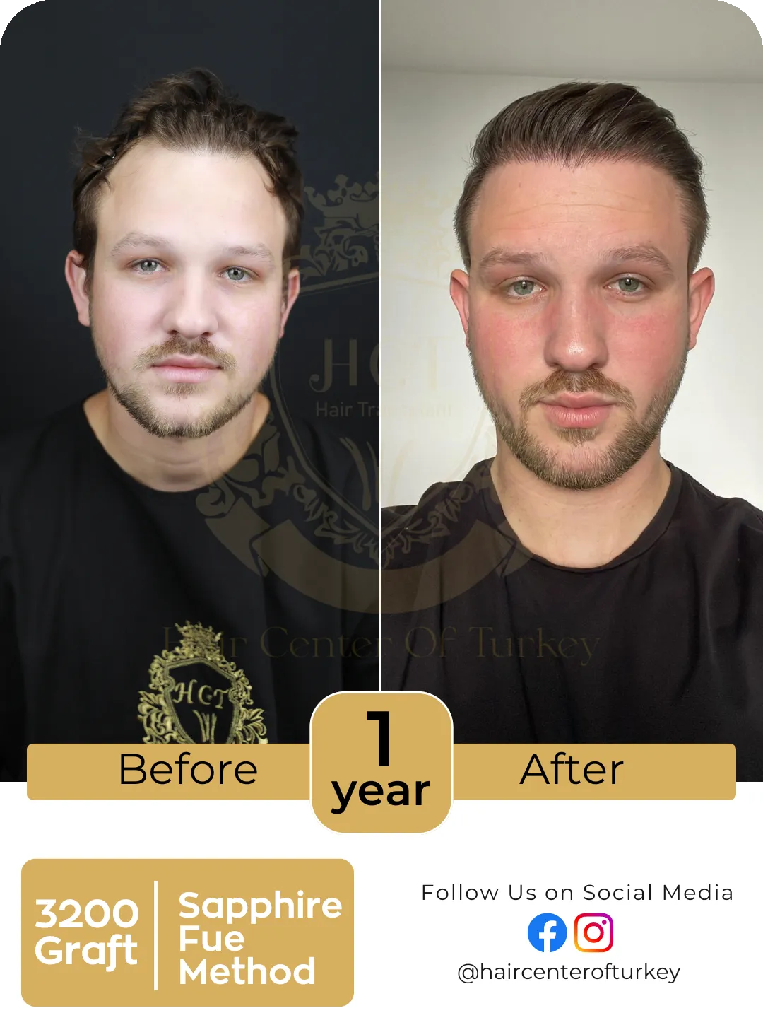 Hair Transplant Before And After