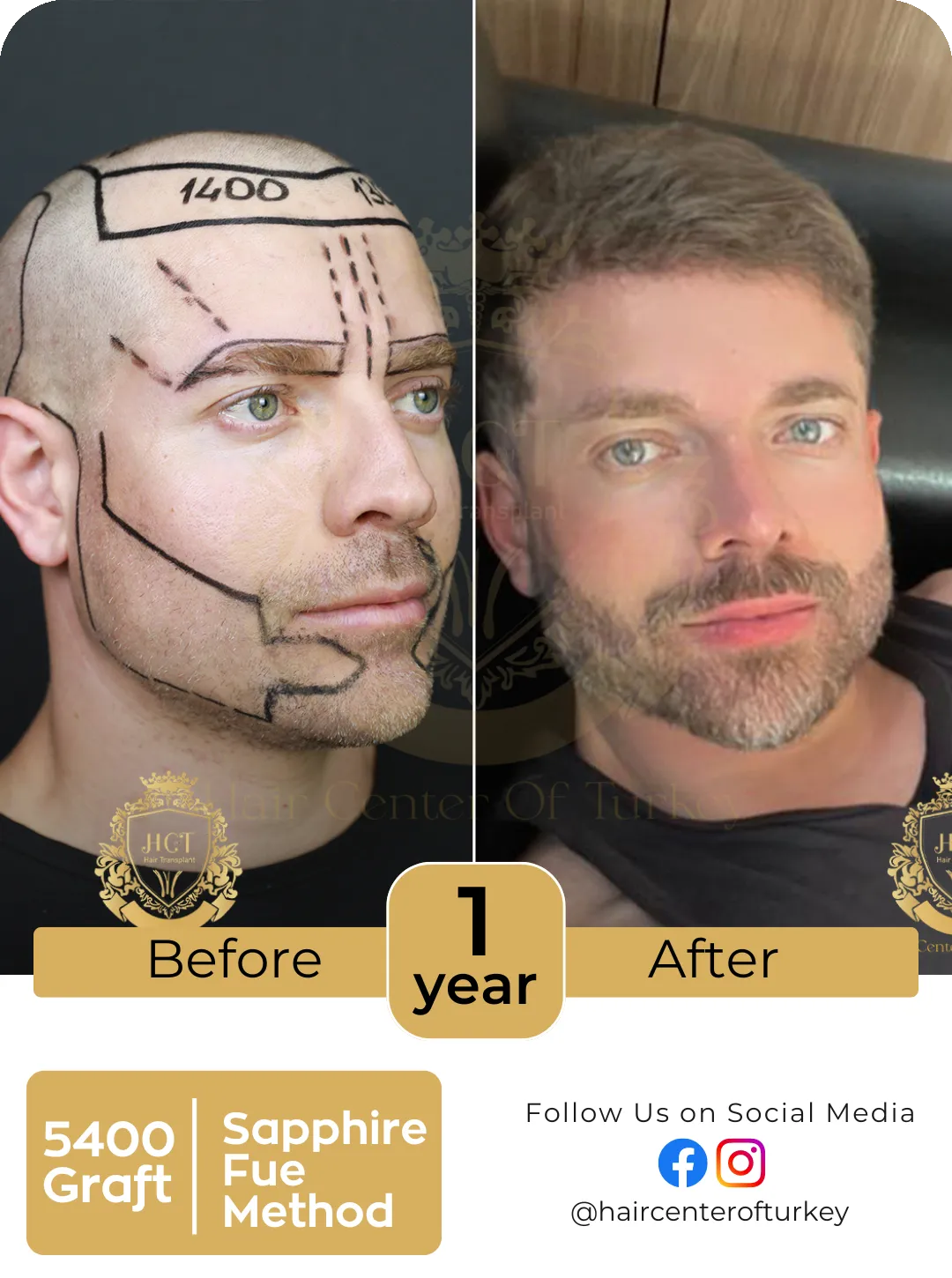 Hair Transplant Before And After