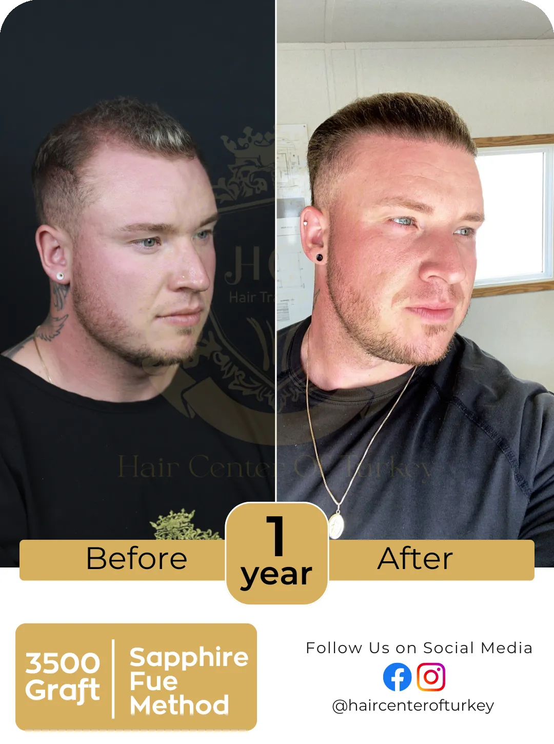 Hair Transplant Before And After