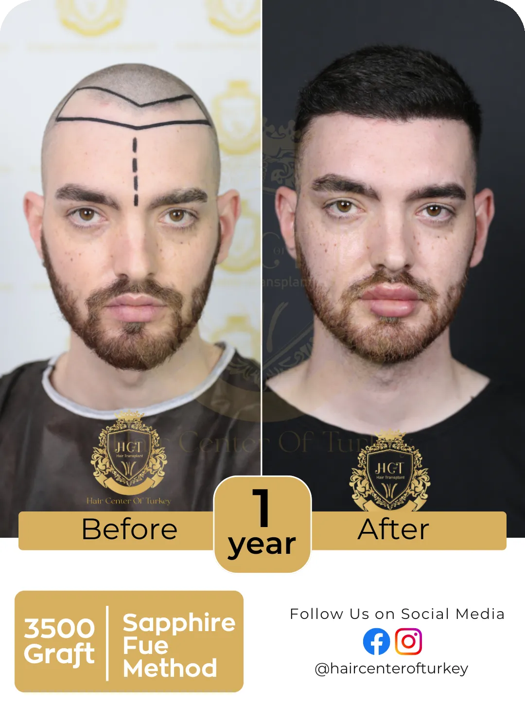 Hair Transplant Before And After