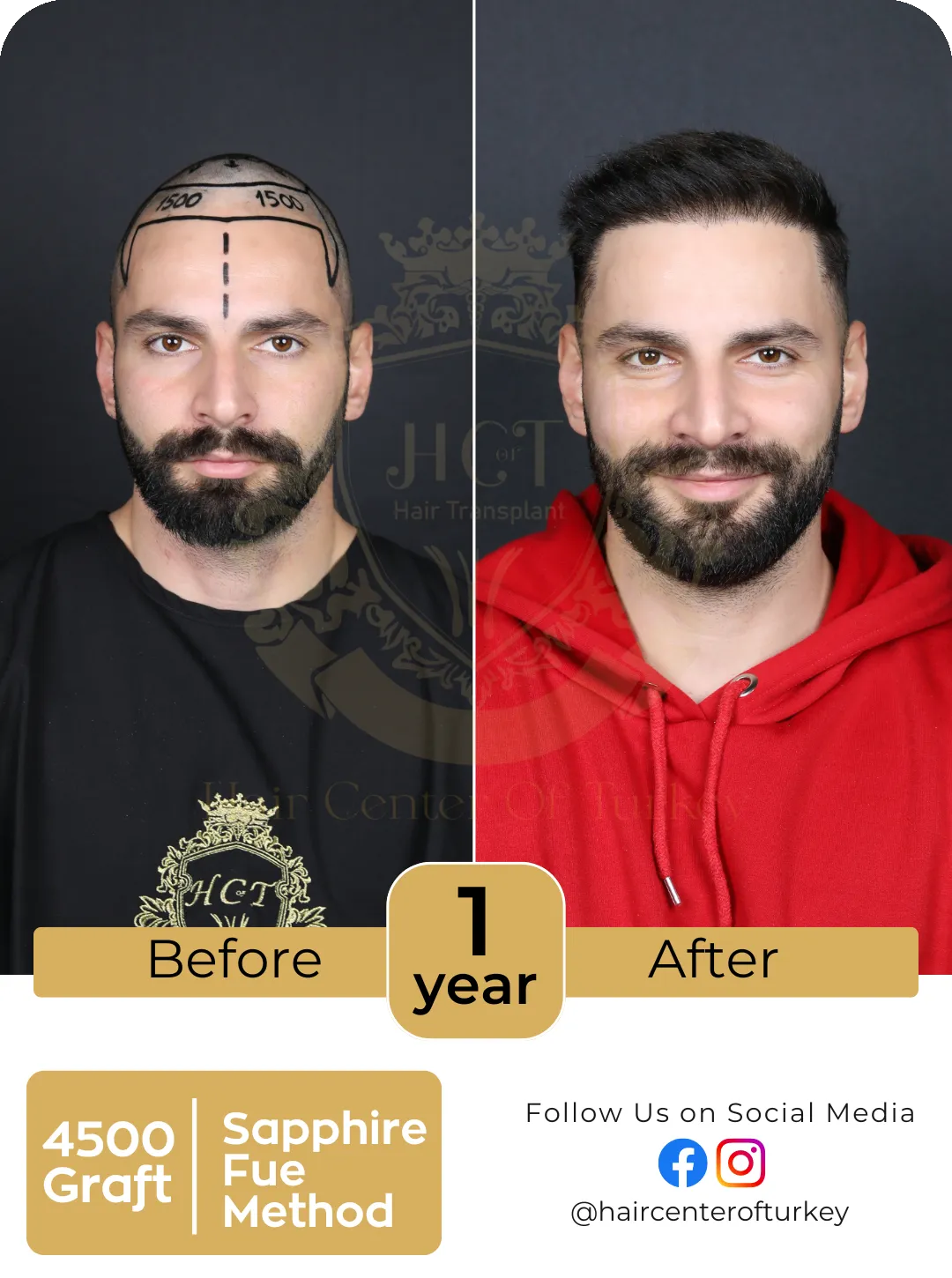 Hair Transplant Before And After