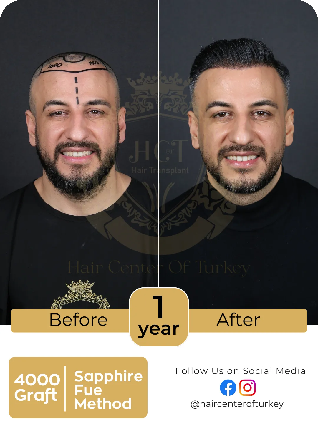 Hair Transplant Before And After