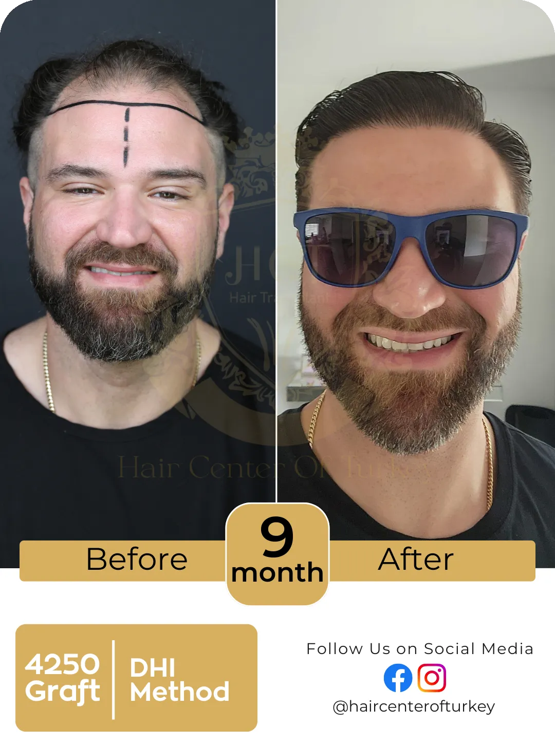 Hair Transplant Before And After