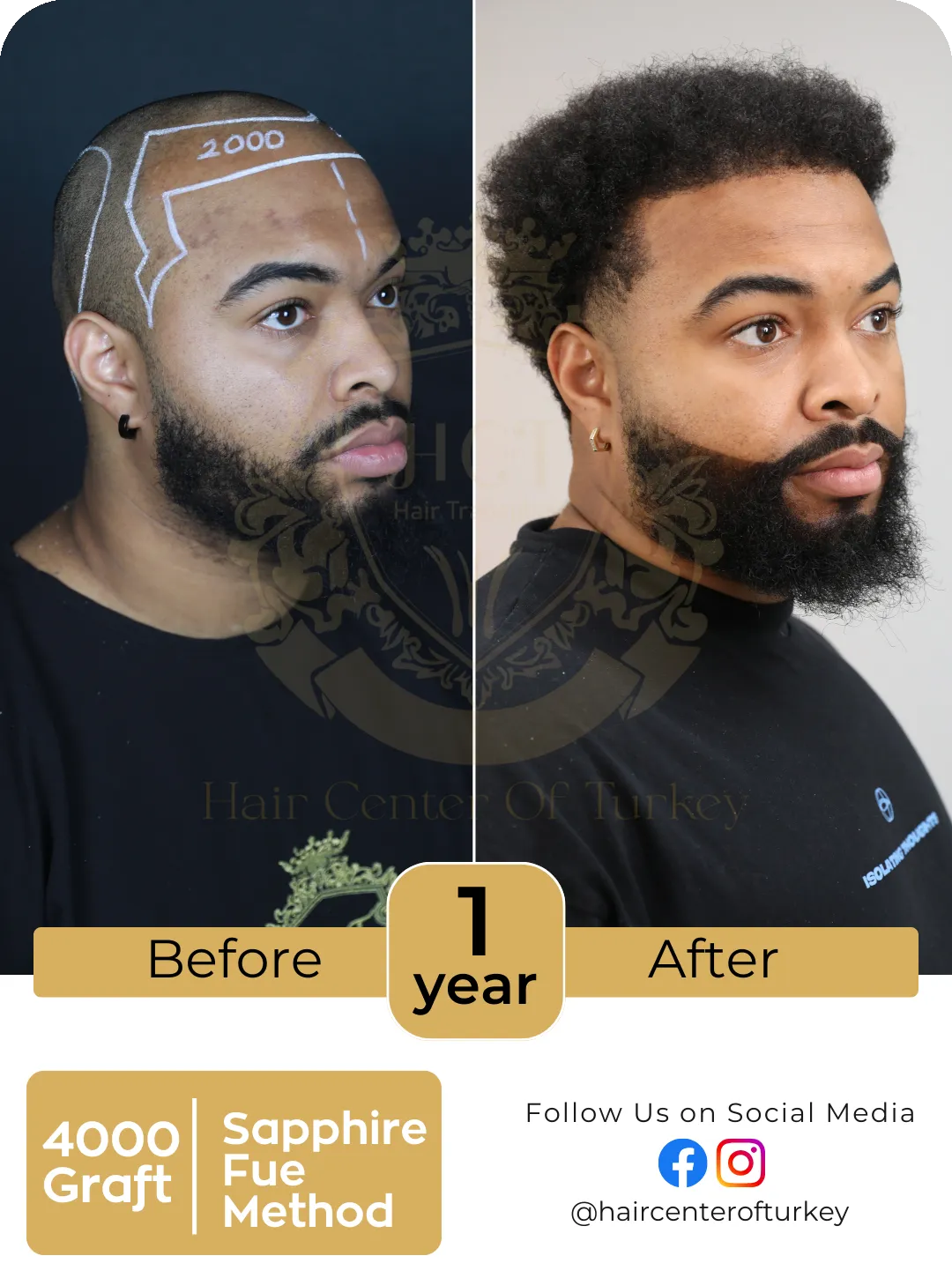 Hair Transplant Before And After