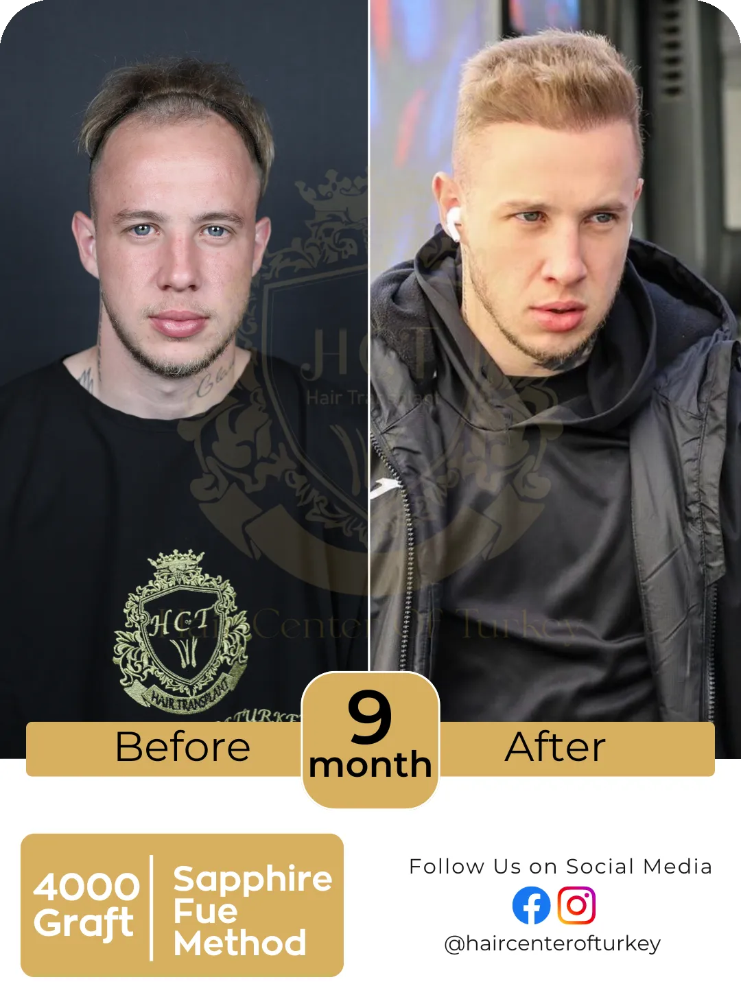 Hair Transplant Before And After