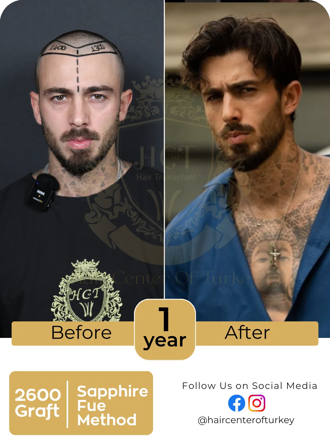 Hair Transplant Before And After