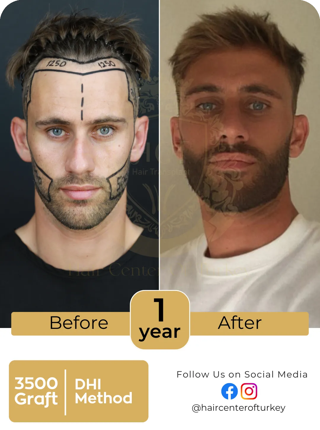 Hair Transplant Before And After