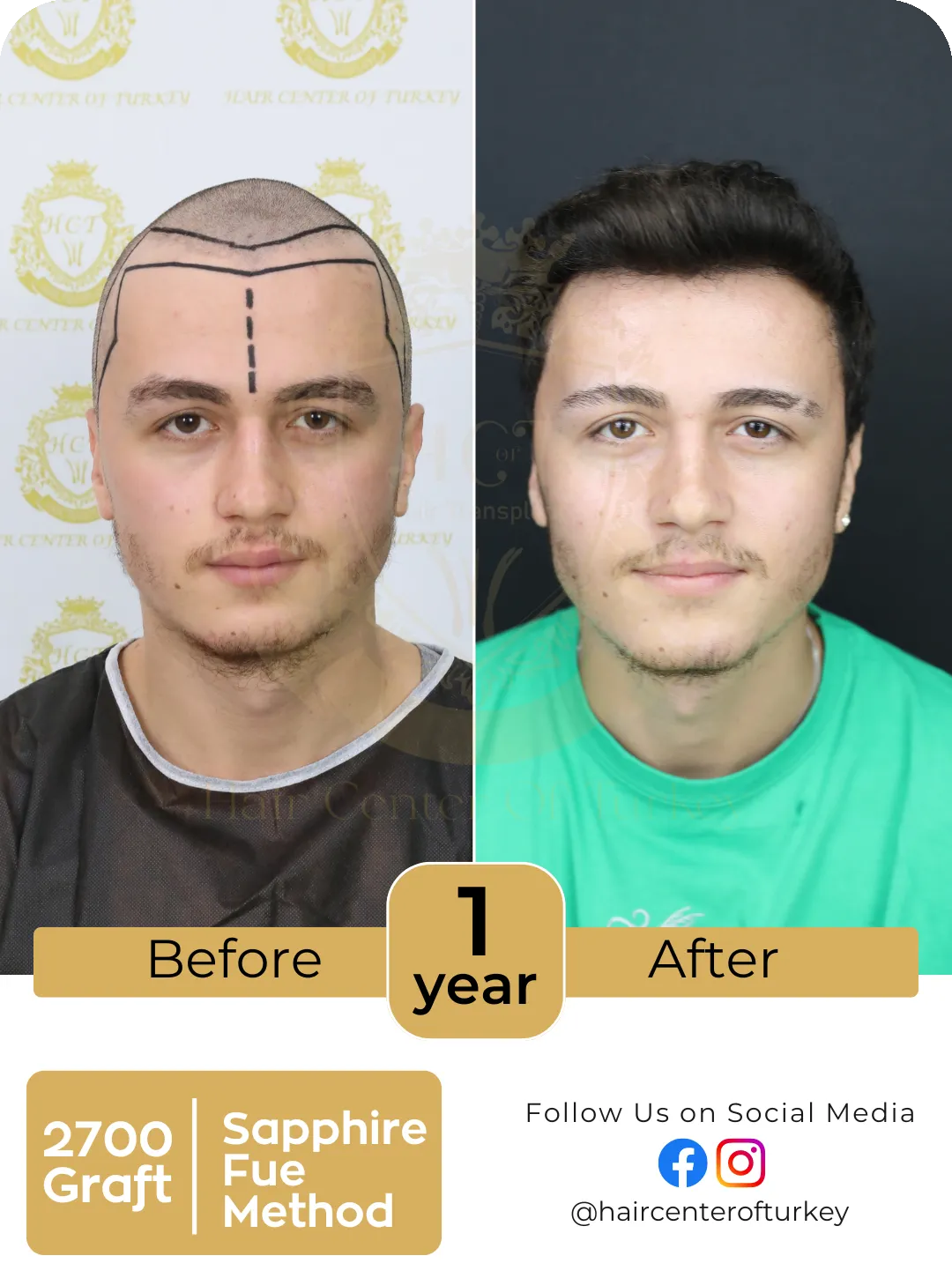 Hair Transplant Before And After