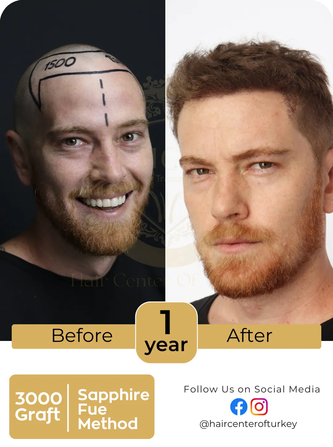 Hair Transplant Before And After