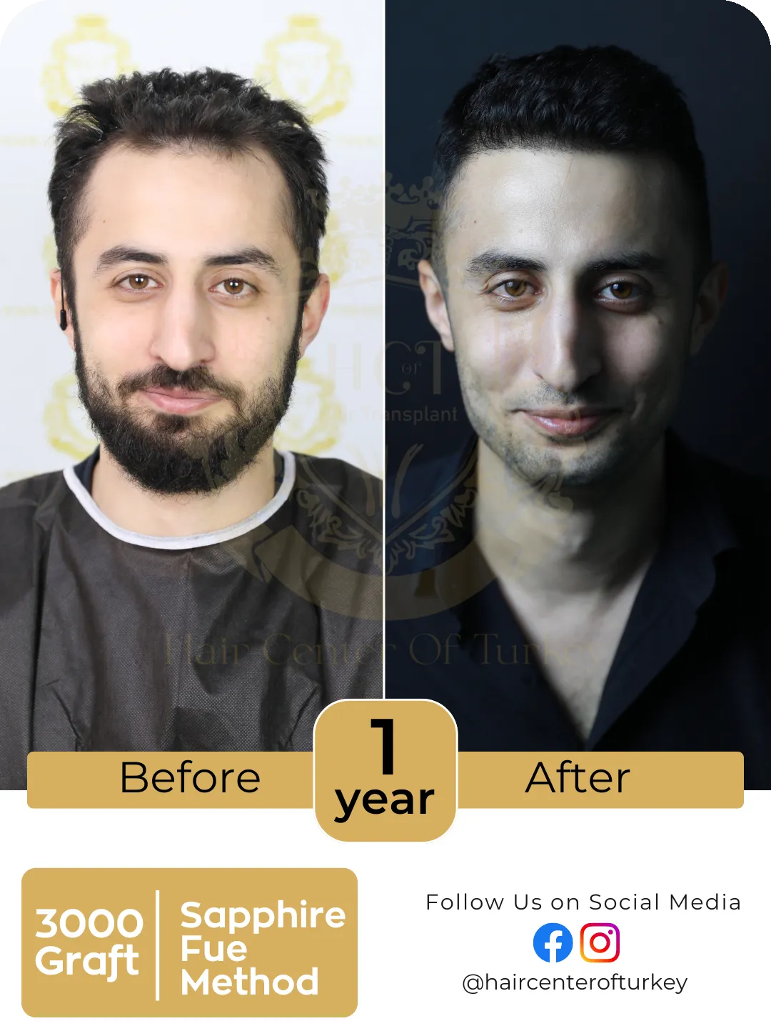 Hair Transplant Before And After