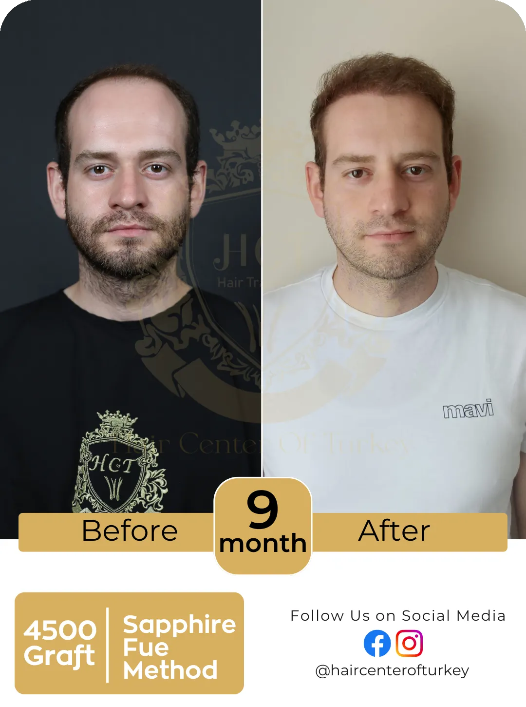 Hair Transplant Before And After