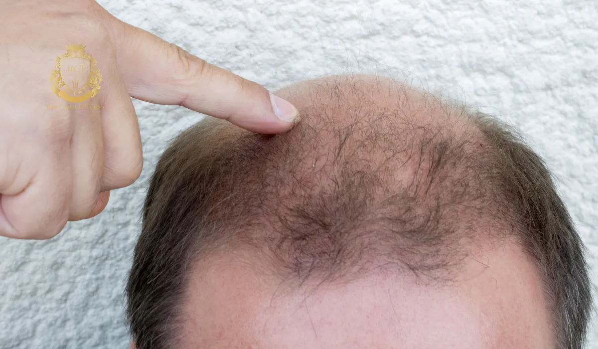 Vitamin Deficiency Causing Hair Loss