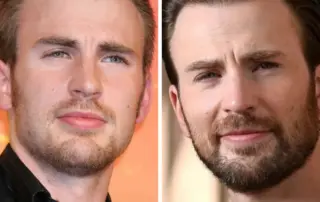 chris evans hair transplant