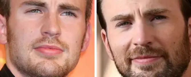 chris evans hair transplant