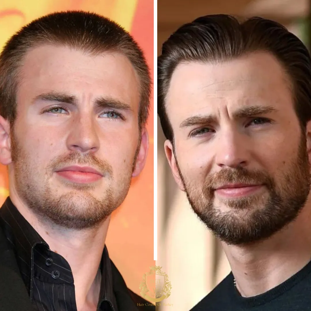 Chris Evans Hair Transplant: Did Chris Evans Get a Hair Transplant ...