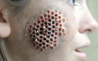 hair transplant trypophobia