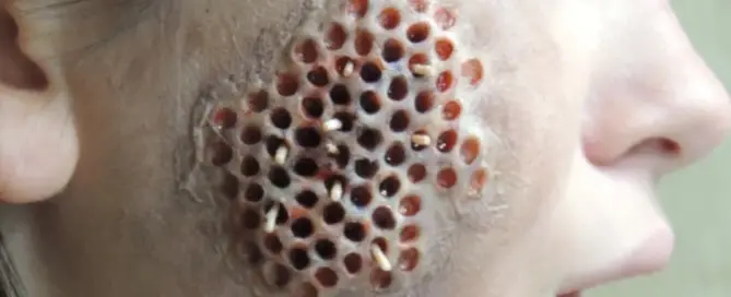 hair transplant trypophobia