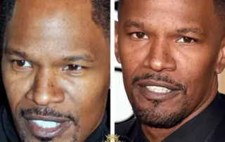 jamie foxx hair transplant