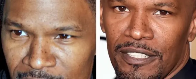 jamie foxx hair transplant