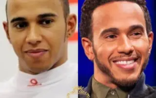 lewis hamilton hair transplant