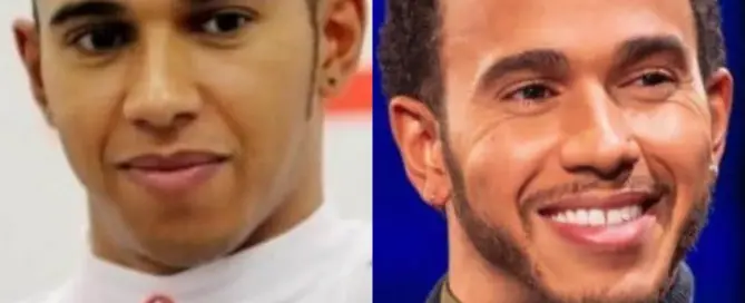 lewis hamilton hair transplant