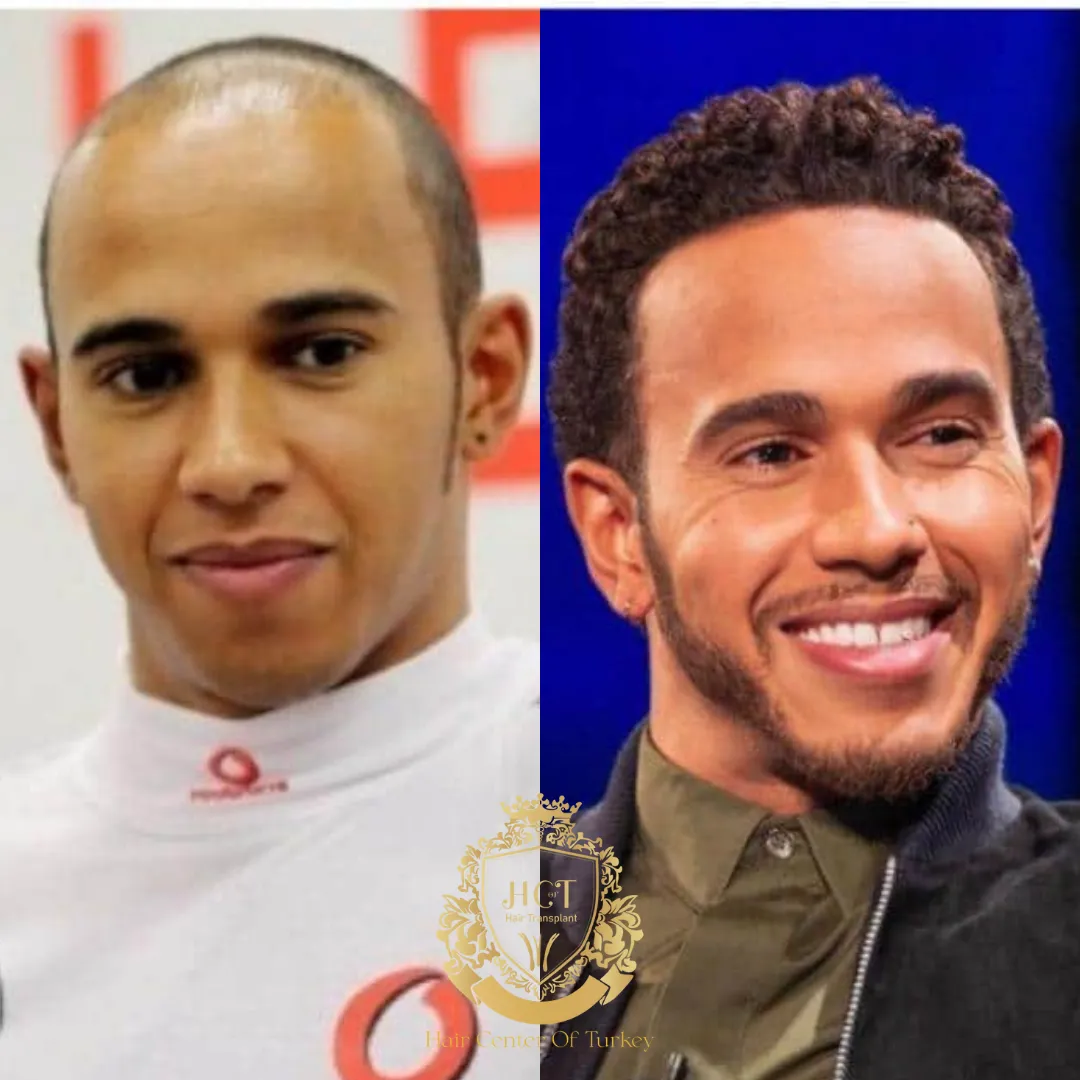 lewis hamilton hair transplant