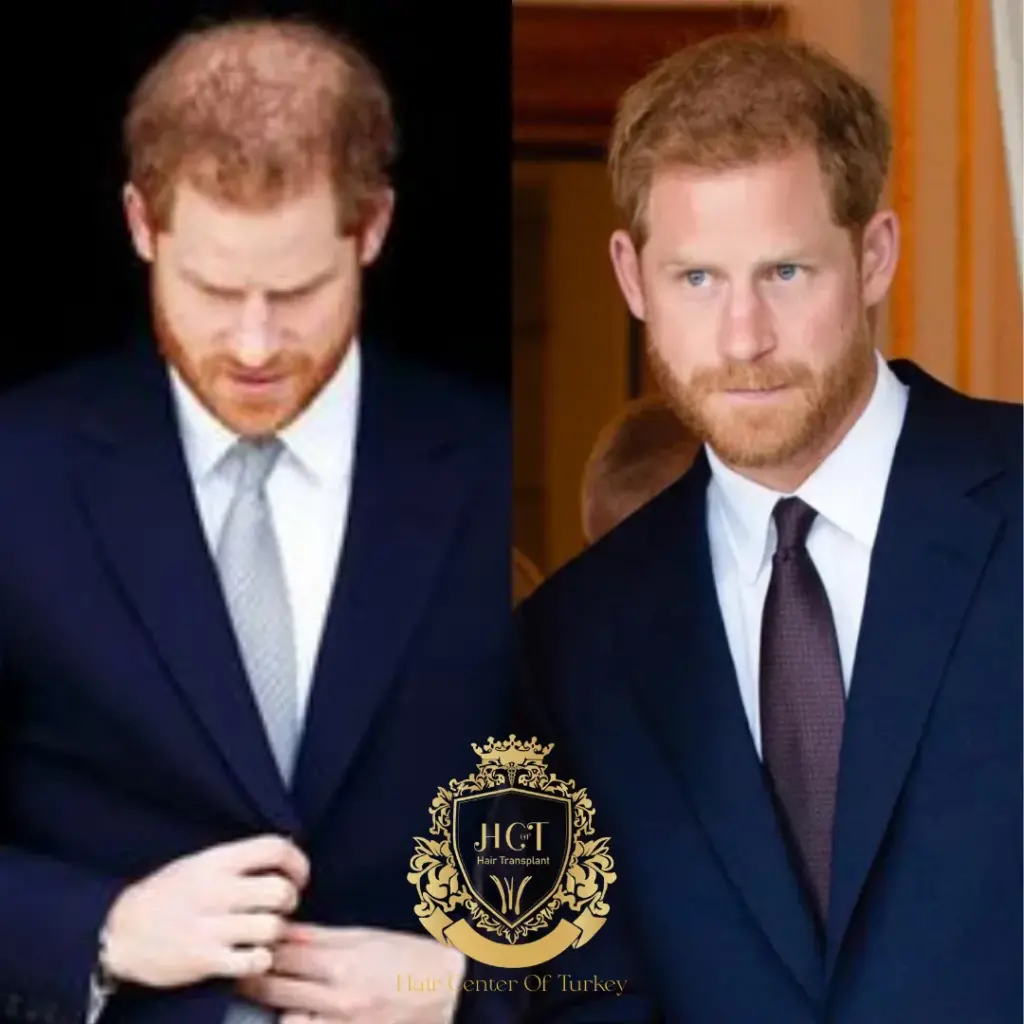 prince harry hair transplant