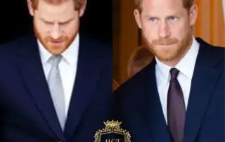 prince harry hair transplant