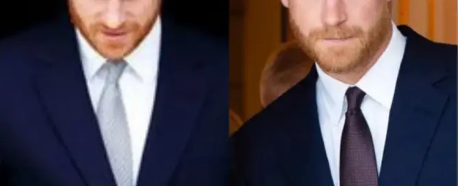 prince harry hair transplant