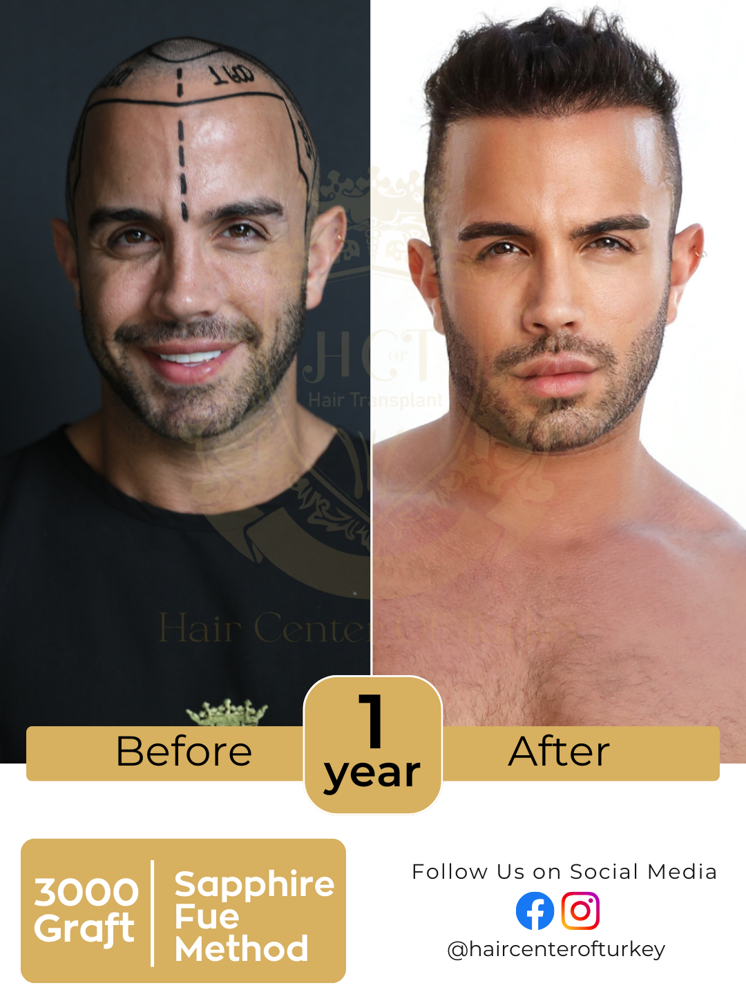 Hair Transplant Before And After