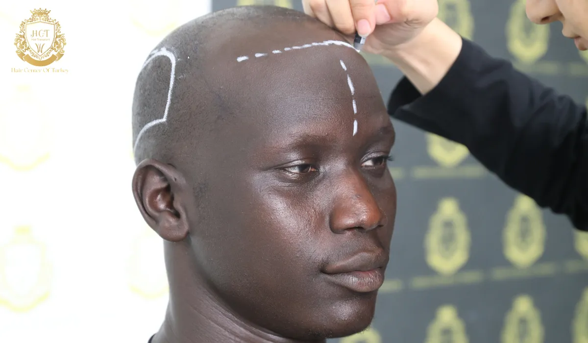 Afro Hair Transplant Near Me