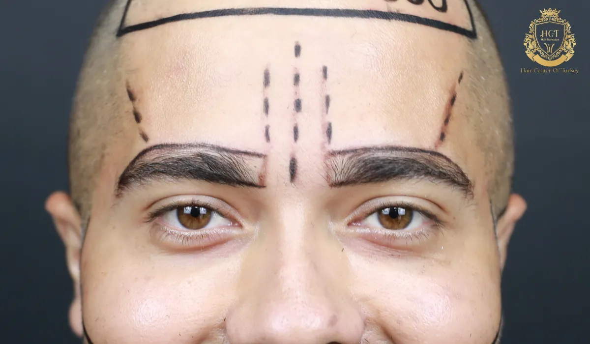 Eyebrow Transplant Near Me