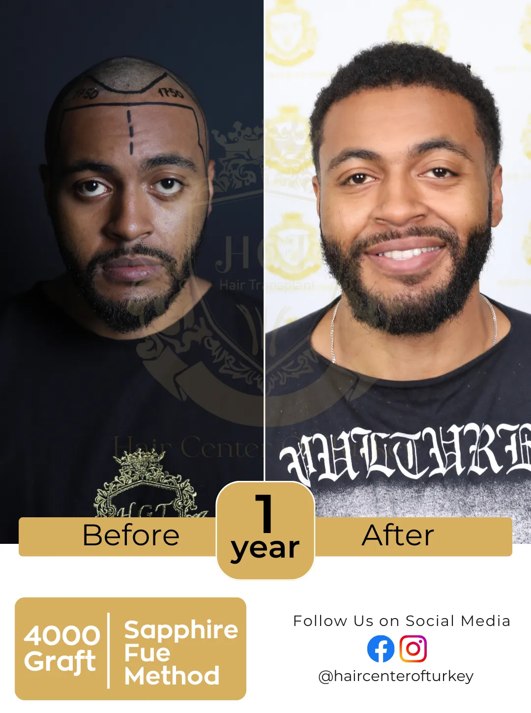 Hair Transplant Before After