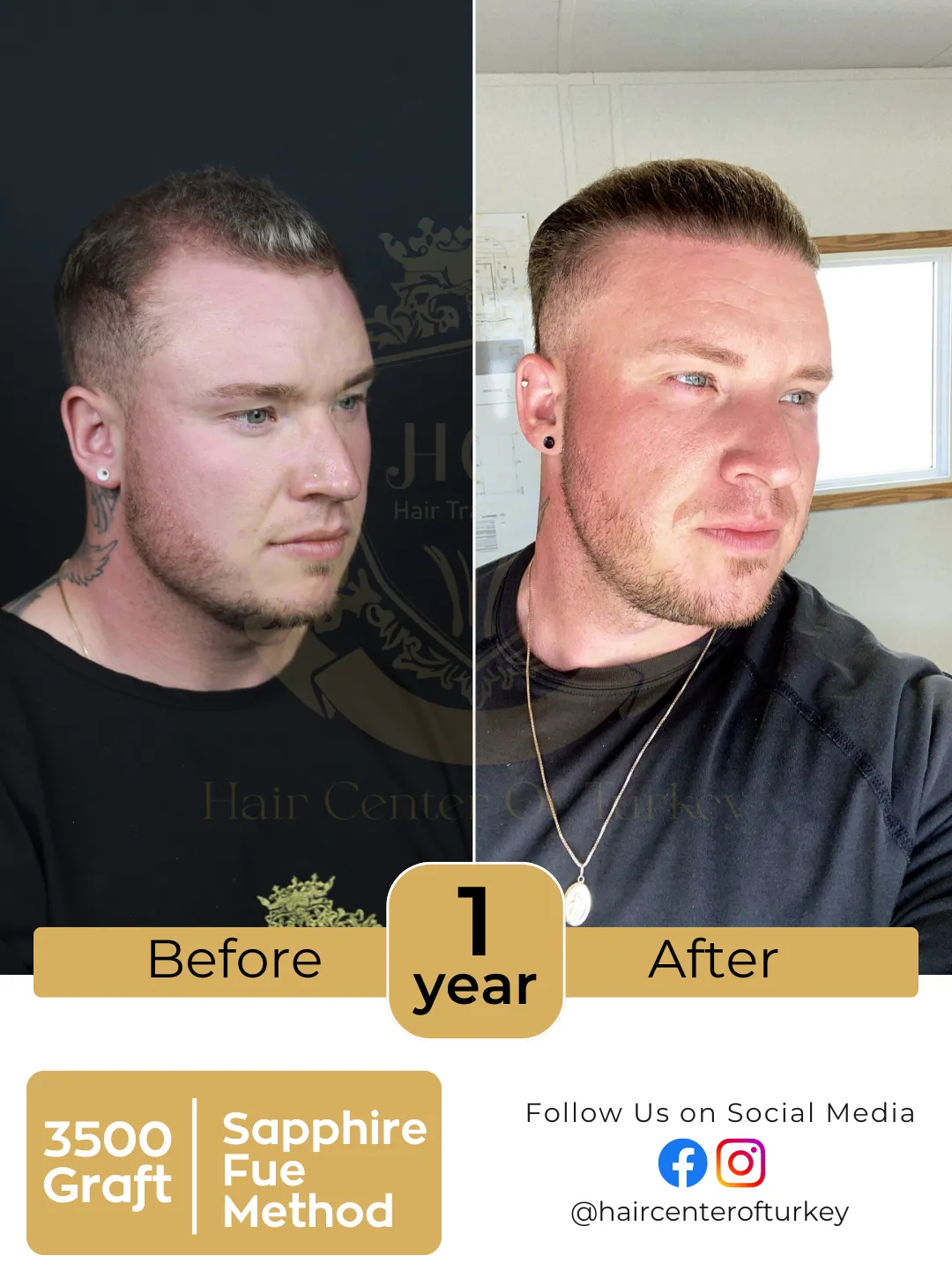 Hair Transplant Before And After