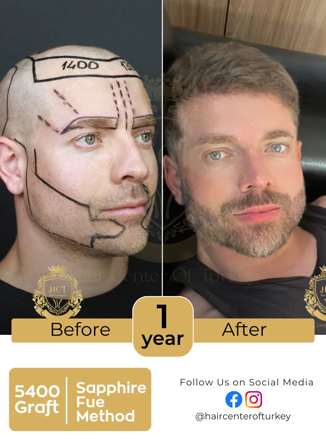 Hair Transplant Before And After