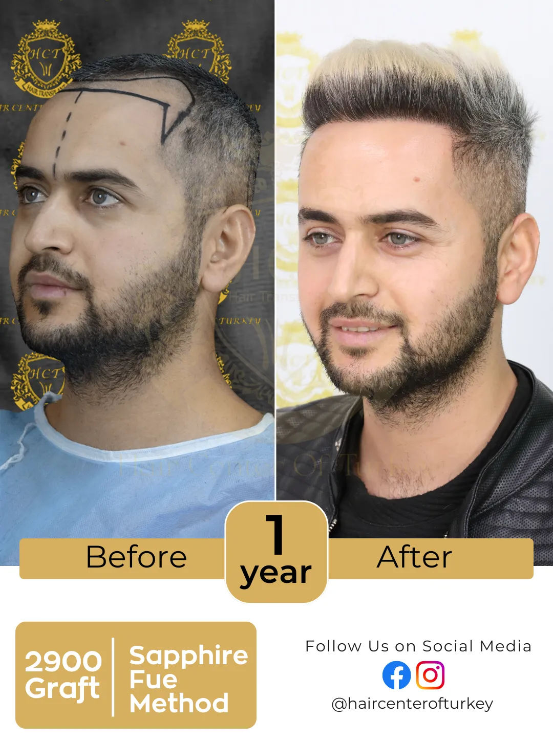 Hair Transplant Before And After