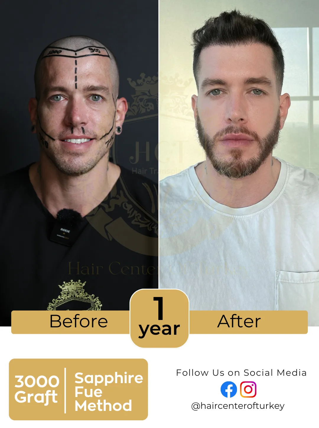 Hair Transplant Before And After