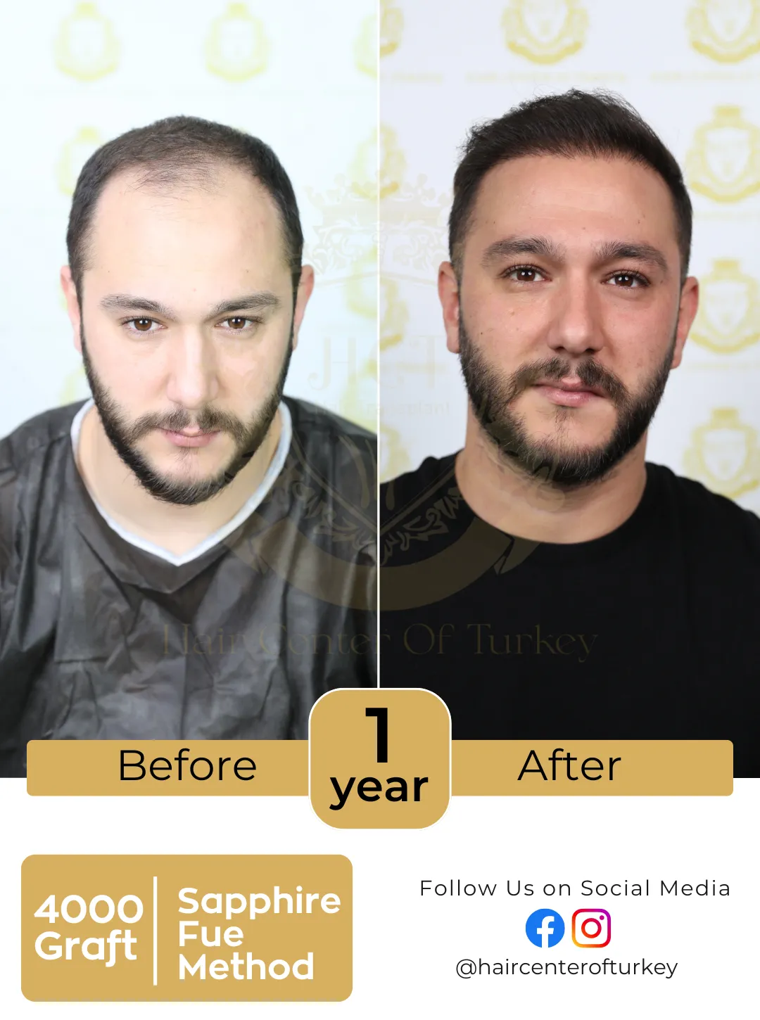 Hair Transplant Before And After