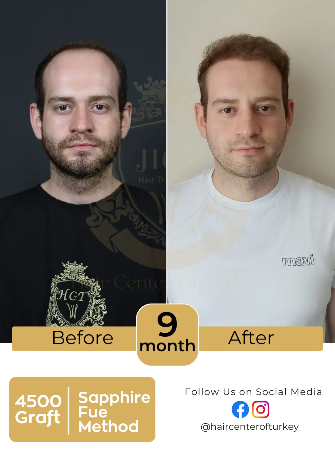 Hair Transplant Before And After