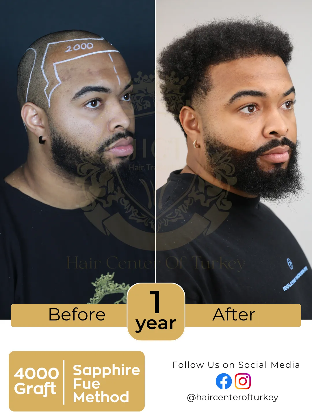 Hair Transplant Before And After