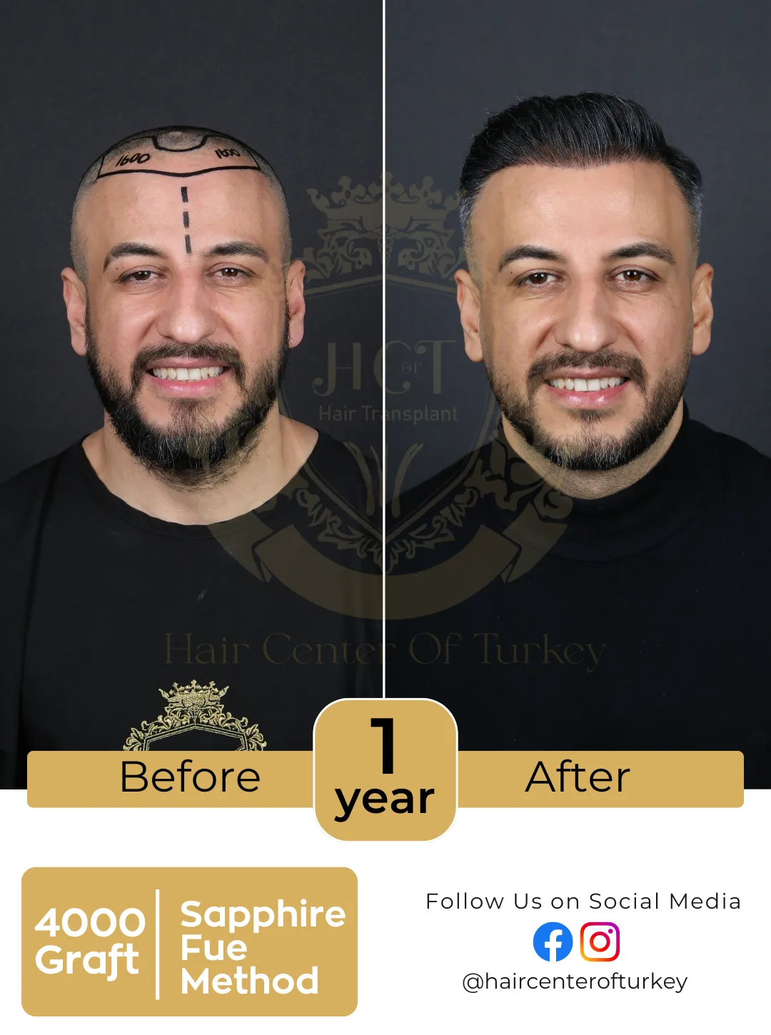 Hair Transplant Before And After 6