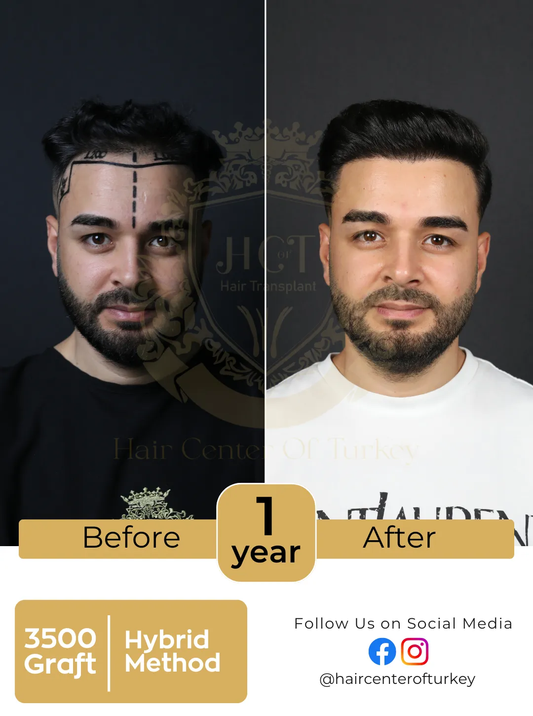 Hair Transplant Before And After